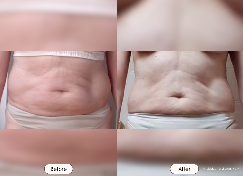 BodySculpt LED Radio frequency before and after results showing tighter slimmer abdomen