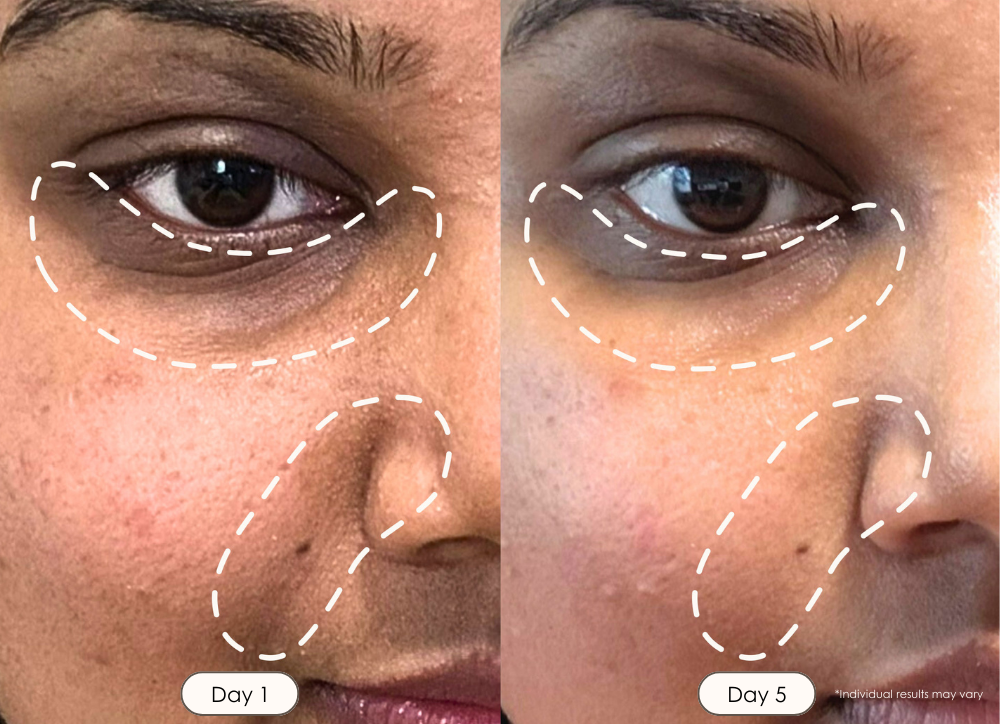 Reva Instant Age Renewal Wand electroporation before and after results for skin tightening and even skin tone