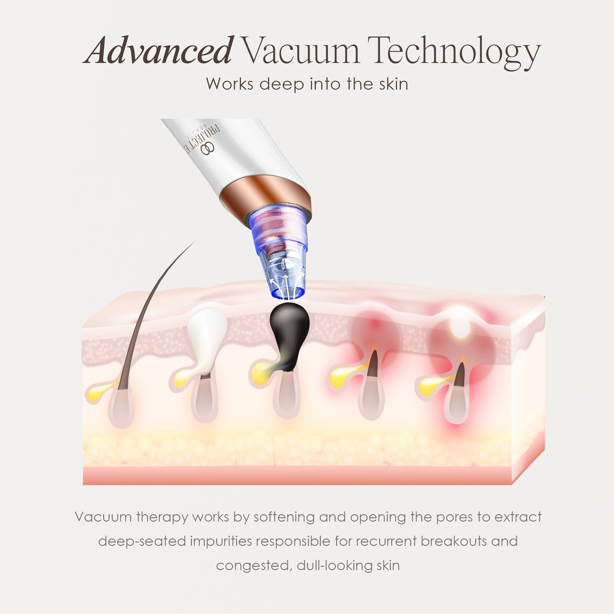 Vana vacuum blackhead remover showing skin infographic on how vacuum suction therapy unclogs pores